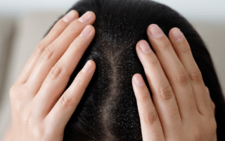 Say goodbye to dandruff