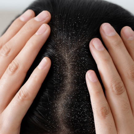 Say goodbye to dandruff