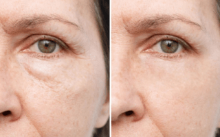 How to Get Rid of Dark Circles and Puffy Eyes Naturally