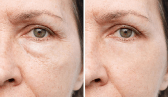 How to Get Rid of Dark Circles and Puffy Eyes Naturally